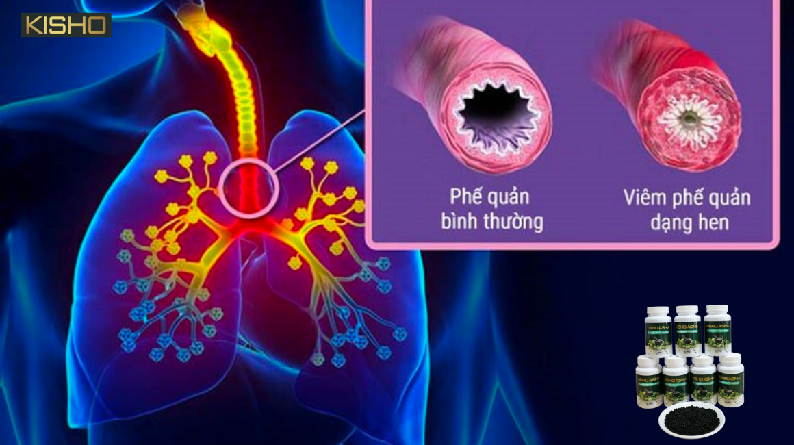 viem-phe-quan-dang-hen-la-gi-1png