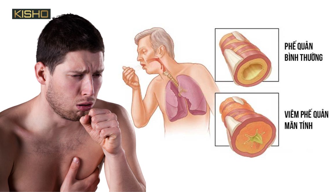 dau-hieu-bi-viem-phe-quan-man-tinh-de-nhan-biet-nhat